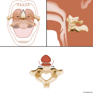 The-transoral-approach-to-the-C1-C2-region-involves-an-incision-through-the-uvula-and-posterior-pharyngeal-wall----The-tongue-is-retracted-caudally---Intubation-is-usually-through-a-nasal-tracheal-root-with-lateral-retraction-of-the-endotracheal-tube-in-the-region-of-the-pharynx--