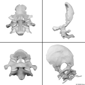 The-principal-ligaments-of-the-occipitalcervical-joint-complex-are-the-alar-ligaments-joining-the-occiput-to-C2--the-apical-joining-the-basion-to-the-dents--transverse-ligament-attaching-to-lateral-aspect-of-C1-on-both-sides-and-wrapping-around-the-dens--and-the-joint-capsules-extending-from-the-occipital-condyles-to-C1-and-from-lateral-masses-of-C1-to-the-lateral-masses-of-C2--