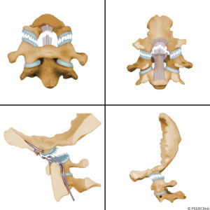 Atlanto-occipital-dissociation-disrupts-the-ligaments-joining-the-skull-to-the-cervical-spine----This-usually-involves-disruption-of-the-alar-ligaments--apical-ligaments--and-joint-capsules----The-bone-displacement-can-occur-between-the-occiput-in-C1-or-between-C1-and-C2--with-C1-remaining-attached-to-the-skull-and-displacing-with-the-occipital-condyles--