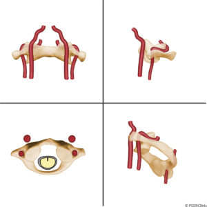 The-carotid-artery-is-immediately-anterior-to-the-C1-lateral-masses----The-vertebral-artery-takes-two-90-degree-turns-at-the-level-of-C1----The-first-involves-posterior-turn-just-cephalad-of-the-transverse-foramina-of-C2----The-second-turn-involves-a-turn-toward-the-midline-at-the-level-of-the-posterior-arch-of-C1--