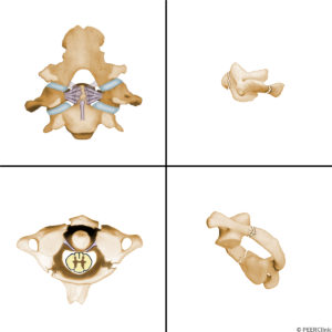 In-splitting-fractures-of-the-C1-ring-(Jefferson-fracture)-lateral-displacement-of-the-lateral-masses-of-C1-can-stretch-and-disrupt-the-transverse-ligament----Injury-to-this-ligament-results-in-increased-mobility-between-C1-and-C2-and-instability-at-this-level--usually-requiring-surgical-fusion--