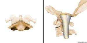 A-Type-II-fracture-of-the-odontoid-process-involves-at-the-junction-between-the-odontoid-process-and-the-C2-vertebral-body----These-fractures-frequently-fail-to-unite----The-bone-in-this-region-is-primarily-cortical----Even-minor-displacements-of-the-fracture-can-lead-to-marked-reduction-in-the-surface-area-available-for-healing----Additionally--the-articulation-between-the-transverse-ligament-and-the-odontoid-process-contains-a-synovial-capsule----Fracture-in-this-region-disrupts-the-synovial-capsule--leading-to-an-interarticular-fracture----Presence-of-the-synovial-fluid-in-the-fracture-site-can-further-impair-bone-healing--