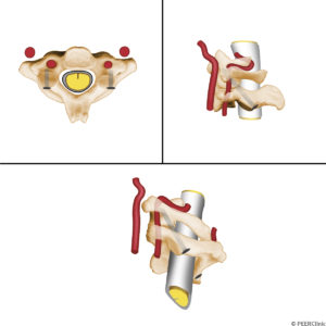 C2-pedicle-screws----The-pedicles-of-the-C2-vertebra-are-directed-toward-the-midline-and-in-the-cephalad-inclination----Pedicle-screws-in-this-area-impose-a-technical-risk-of-injury-to-the-vertebral-artery-laterally--the-brain-stem-and-dura-medially--C2-nerve-root-in-a-cephalad-direction-and-C3-nerve-root-in-a-caudal-direction----Inferiorly-the-carotid-artery-is-at-risk-for-injury--