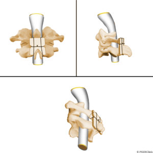 A-galley-fusion-between-the-C1-and-C2-vertebral-bodies-is-a-posterior-fusion-between-the-posterior-arches-of-C1-and-C2----Bone-grafts-rest-on-the-posterior-surface-of-the-C1-arch-and-the-posterior-surface-of-the-C2-arch----The-wire-wraps-around-C1--sublaminar-to-C1-and-around-the-spinous-process-of-C2----The-wire-does-not-encroach-the-spinal-canal-at-C2--