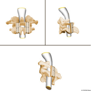 A-Brooks-type-fusion-is-a-posterior-C1-C2-arthrodesis----The-bone-graft-rests-on-the-caudal-surface-of-the-C1-arch-and-the-cephalad-surface-of-the-posterior-arch-of-C2----The-posterior-wires-are-sublaminar-to-both-C1-and-C2--